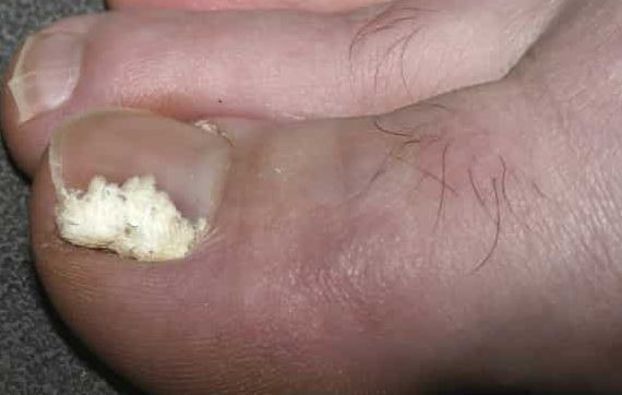 white-spots-on-toenails-meaning-causes-marks-pictures-treatment