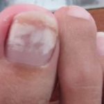 White Spots on Toenails after removing Polish