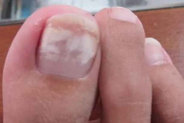 White Spots on Toenails after removing Polish