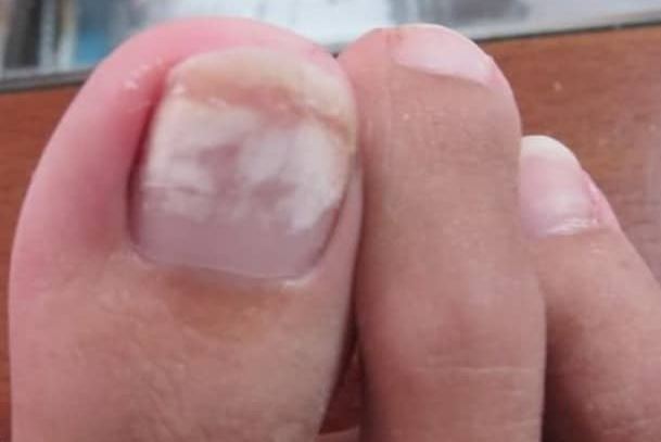 what-are-white-spots-on-toenails-design-talk