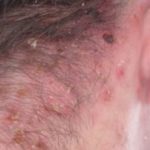 Image of Shingles on Scalp and Neck