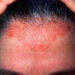 Picture, Image of Shingles on Scalp