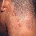 Shingles on Scalp image