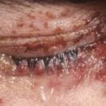 Shingle in the Eye Symptoms