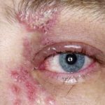 Shingle rash over the eye