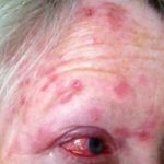 Shingles on Forehead and in the Eye Picture