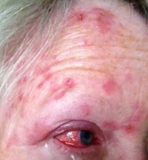 Shingles in Eye, Eyeball, Pictures, Symptoms, Without Rash, Contagious