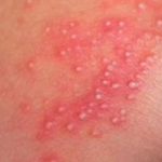 Yeast Infection Bumps, Pimples Pictures