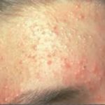 yeast infection Pimples on Face