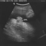 Swollen Labia Ultrasound Pictures