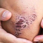 How to Get Rid of Scabs Fast and Naturally