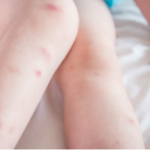 Bed-Bug-Bites-Picture