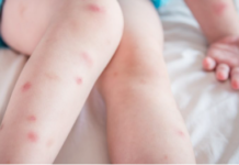 Bed-Bug-Bites-Picture