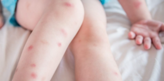 Bed-Bug-Bites-Picture