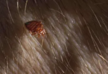 Bed-Bugs-In-Hair-Pictures