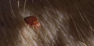 Bed-Bugs-In-Hair-Pictures