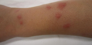 Pictures-of-bed-bugs-bites